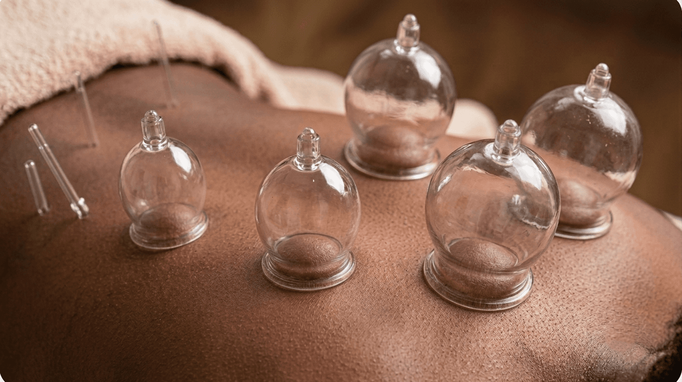 Hijama (Wet Cupping)